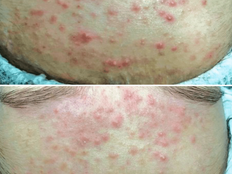 Атравматична чистка