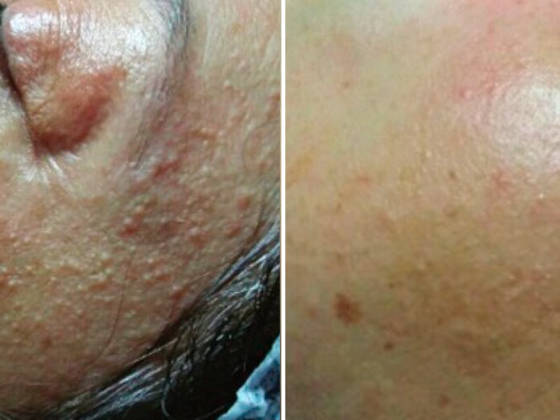 Ферментативно-кислотний (молочний) пілінг