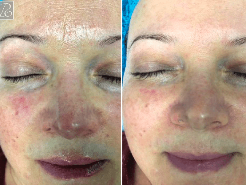 Ліпосомальний пілінг