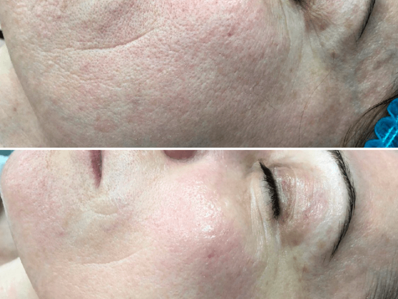 Ліфтинг і освітлення