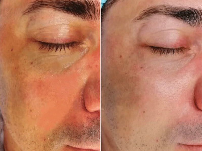 Ліфтинг із термоактивною гіпсовою маскою "ilcsi"