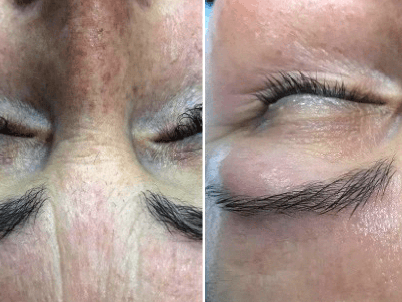 Анти-мелазма