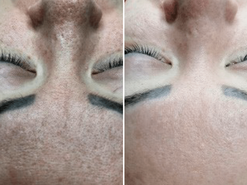 Мікронідлінг глибоке зволоження і ліфтинг