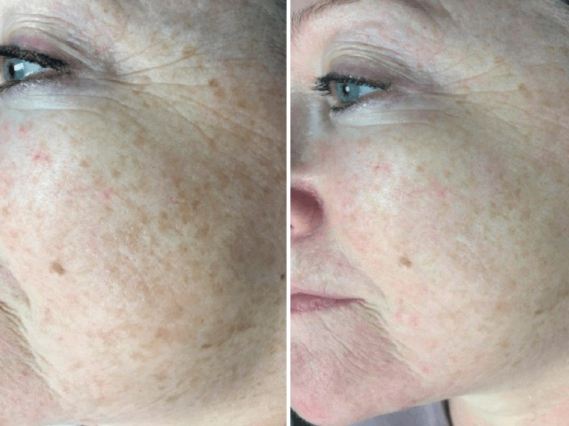 Ретиноловий пілінг