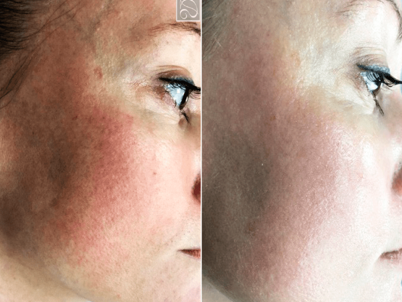Лікування куперозу та розацеа
