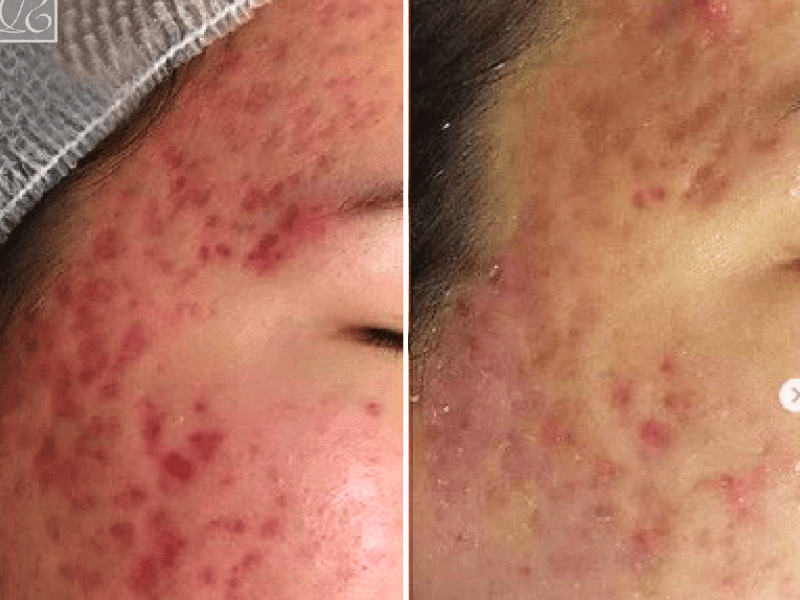 Унікальна методика видалення рубців / розтяжок