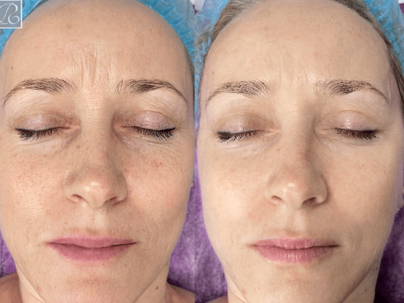 Зволоження і ліфтинг сухої шкіри